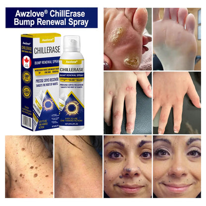 Timilk ChillErase Bump Renewal Spray Reduce Body Acne Skin Soothing Formula 60ML